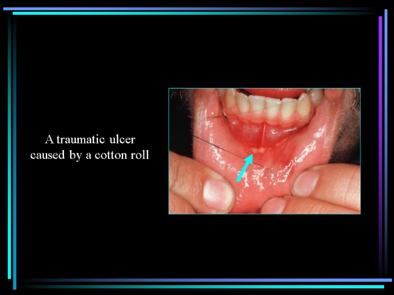 A traumatic ulcer caused by a cotton roll